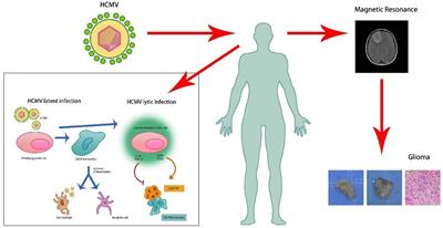 A novel deep learning model for glioma epilepsy associated with the identification of human cytomegalovirus infection injuries based on head MR